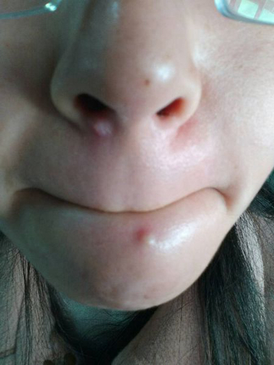 血熱的症狀痘痘