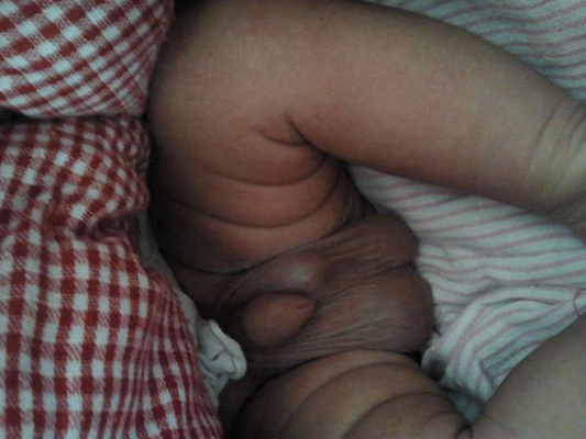 男寶寶疝氣的症狀