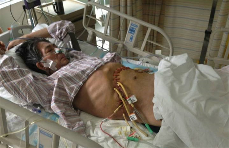 重症急性胰腺炎術後