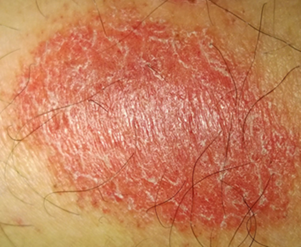 這個是不是放射性皮炎