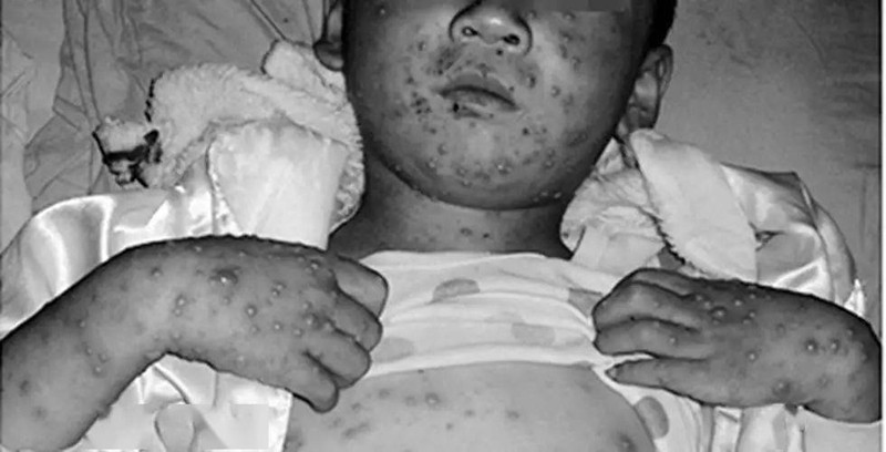 天花是什麼症狀