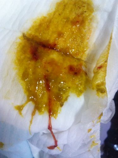 腸癌的症狀 (48) 