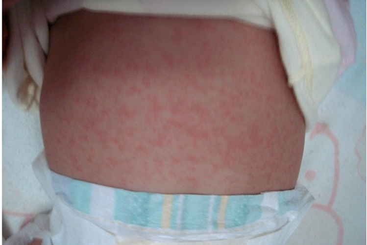 幼兒急疹肚皮上疹子 