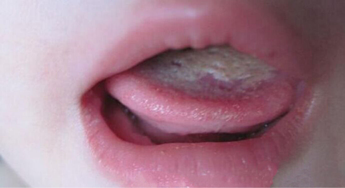 小孩皮膚念珠菌病