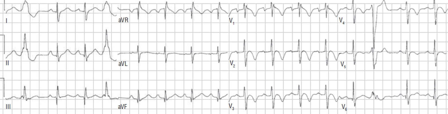 高鉀血癥心電圖 (53) 