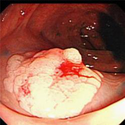 直腸息肉在肛門的