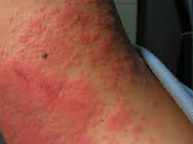 脖頸紅腫嚴重異位性皮炎