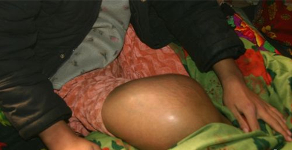 幼兒骨肉瘤腿部