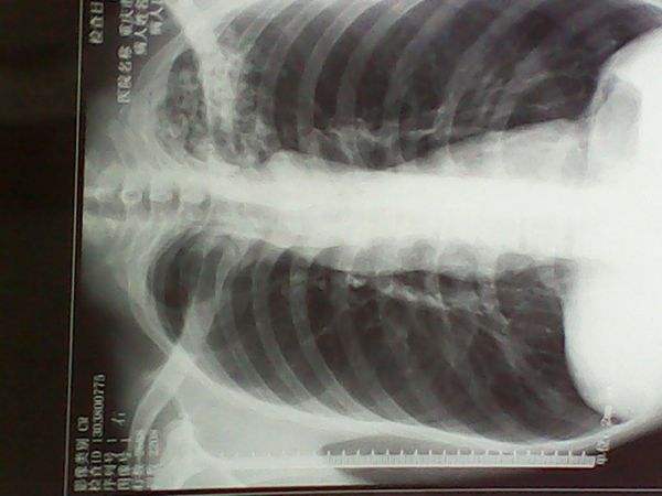 空洞型肺結核能活多久 (49) 