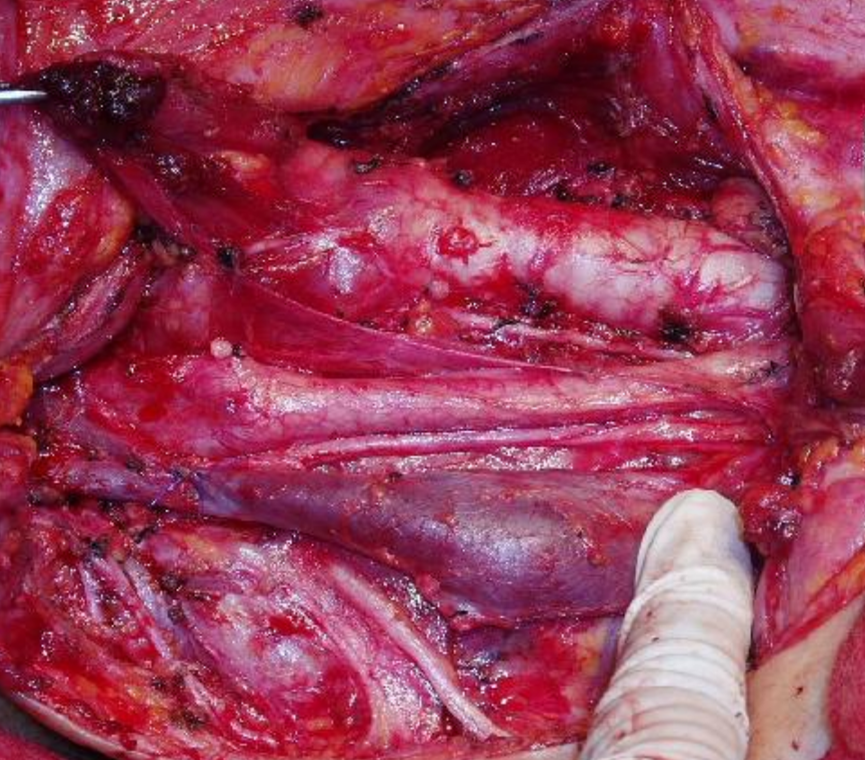 腋窩淋巴瘤症狀