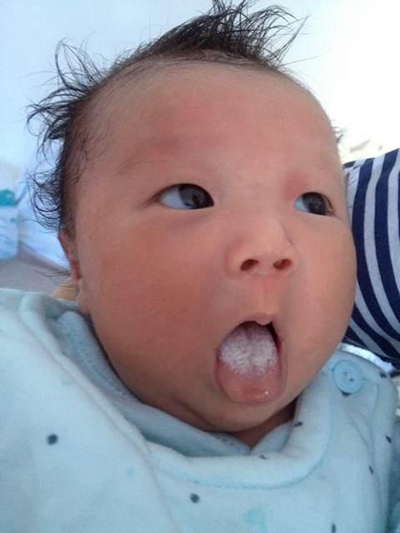 口腔念珠菌感染 (39) 