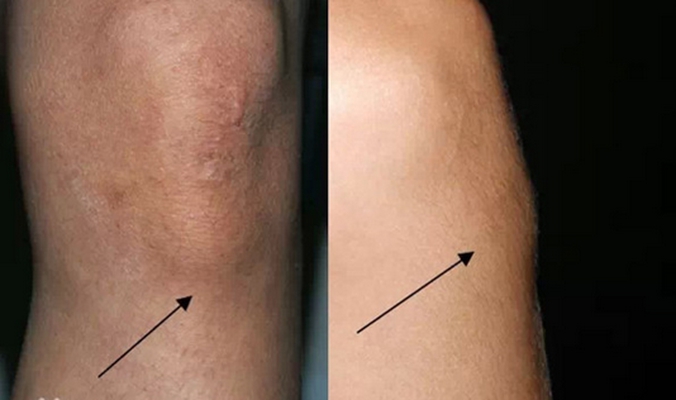 膝蓋骨質增生 (40) 