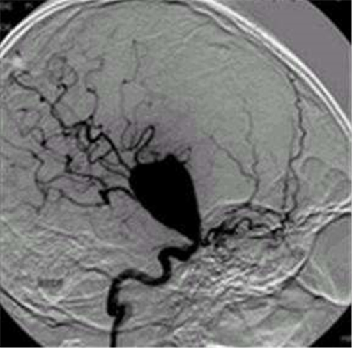 腦供血不足危害