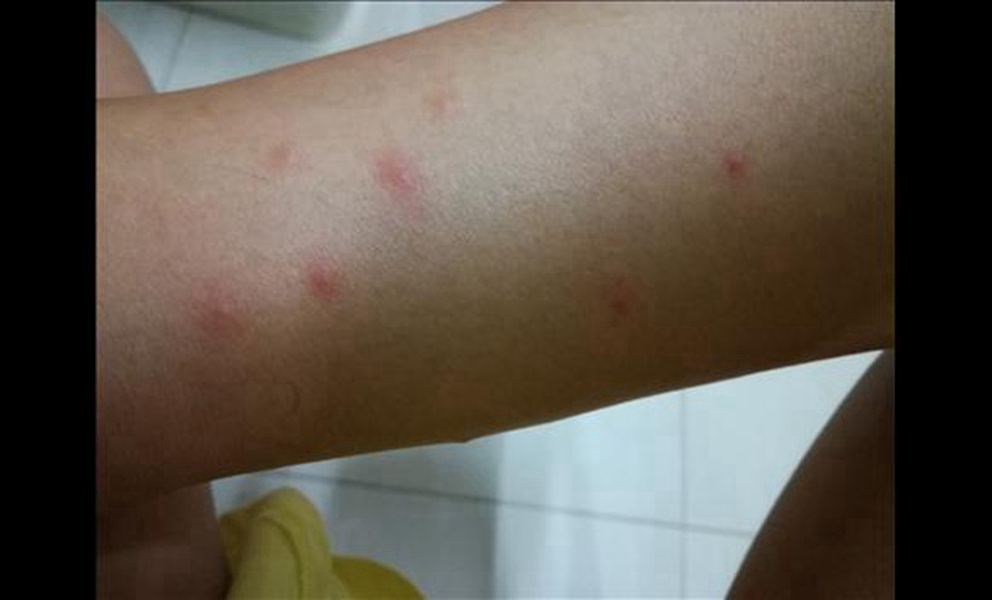 症狀初期流感檢查