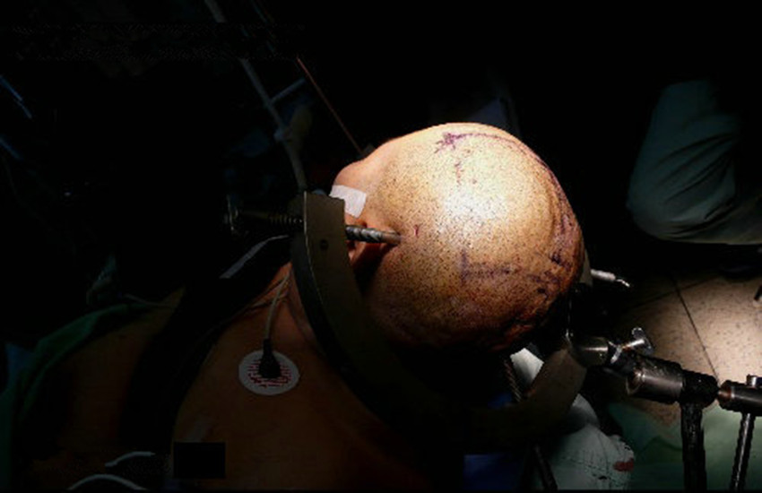 伽馬刀治療腦膜瘤效果