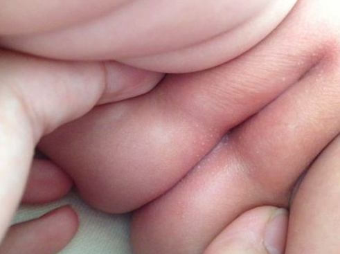 寶寶紅屁屁照片 (52) 