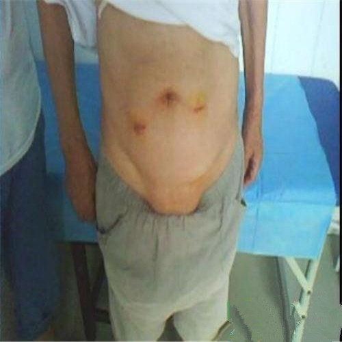 白線疝術後展示