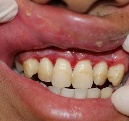 牙齦炎和牙周炎