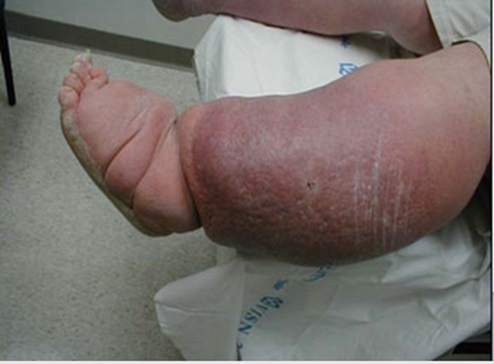 肢端肥大症  (47) 