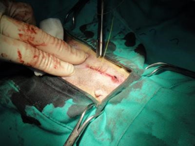 子宮脫垂怎樣手術