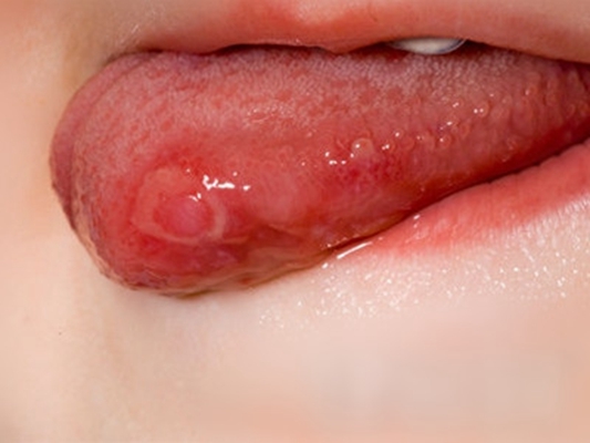 口腔癌的前兆 (39) 