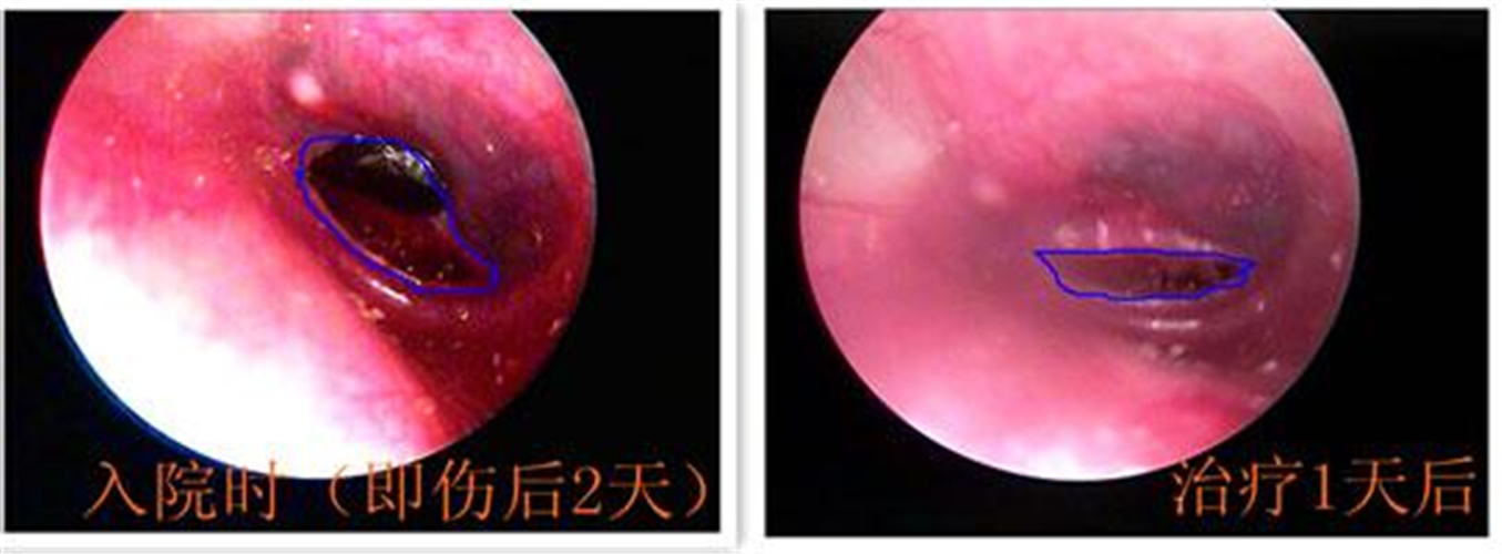 住院治療鼓膜穿孔