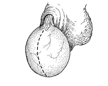 精索曲張睪丸下墜時