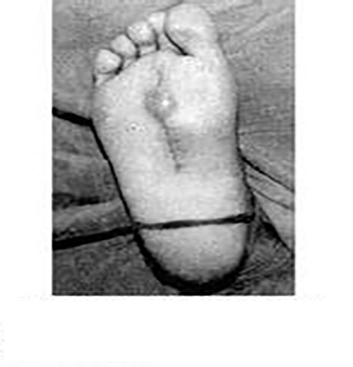 足底滑膜肉瘤症狀