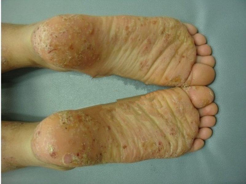 足部異位性皮炎