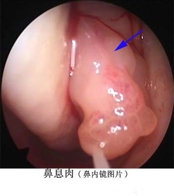 鼻息肉