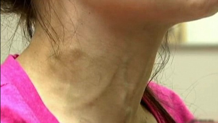 頸靜脈怒張 (50) 