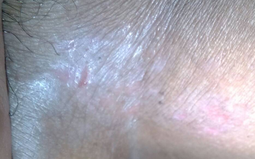體股癬初期現象
