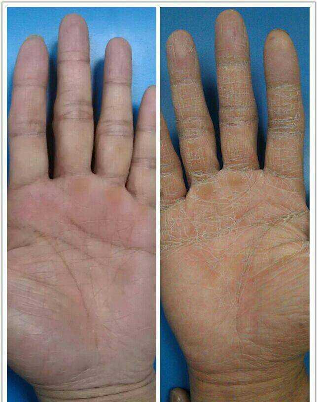 正常的手和放射性皮炎的手