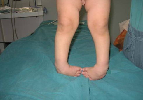 痙攣型腦癱 (51) 