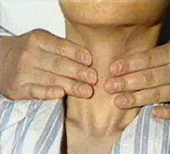 亞急性甲狀腺炎的症狀