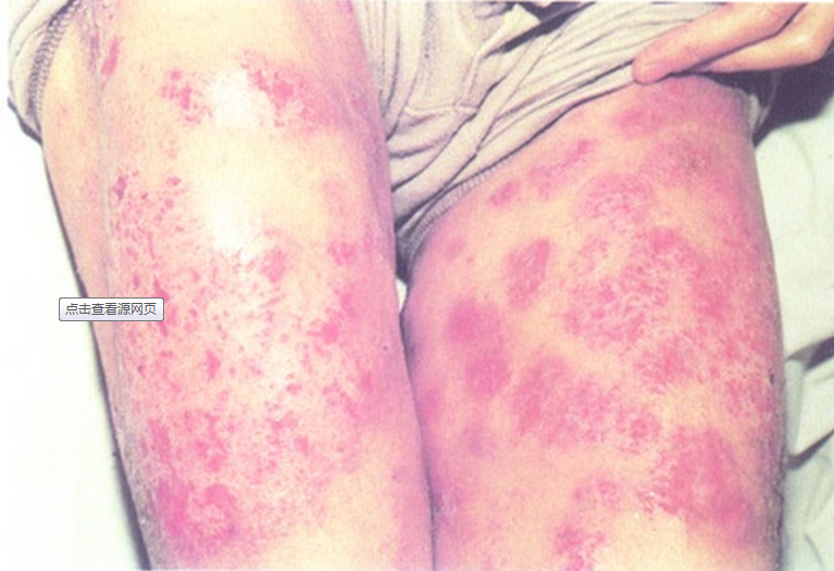 腿部日光性皮炎