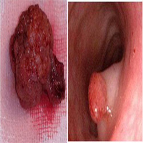 痔瘡與直腸息肉