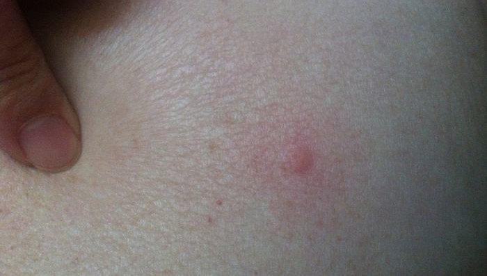 被跳蚤咬的症狀