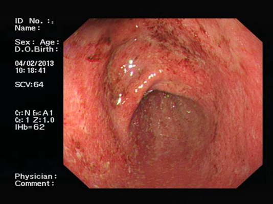 食道炎症狀 (47) 