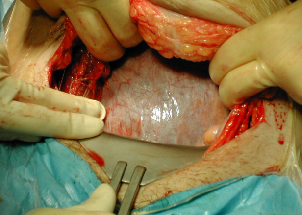 剖腹產手術 (56) 