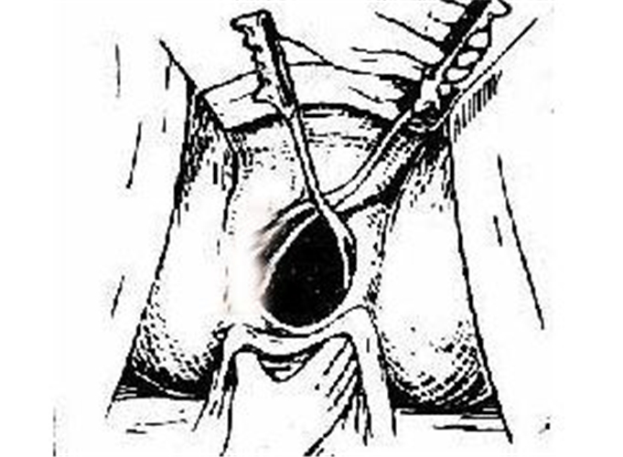 生產時會陰撕裂