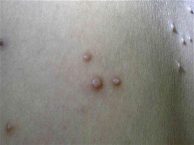 傳染性軟疣怎麼引起的 