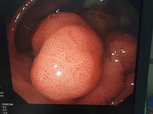食道炎症狀 (48) 