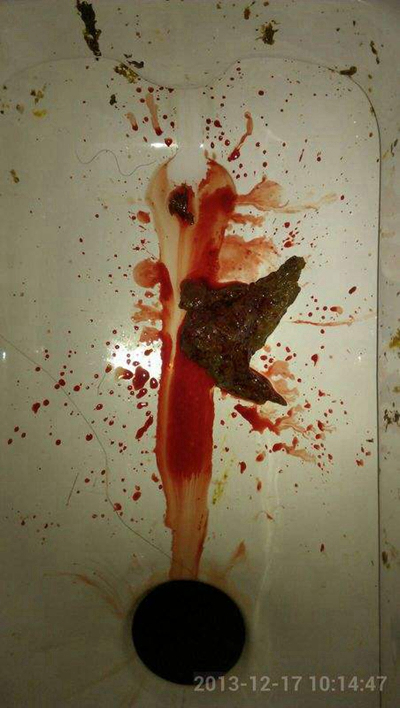 結腸癌症狀 (50) 