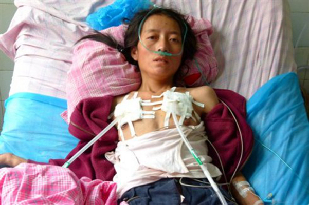 空洞型肺結核能活多久 (37) 