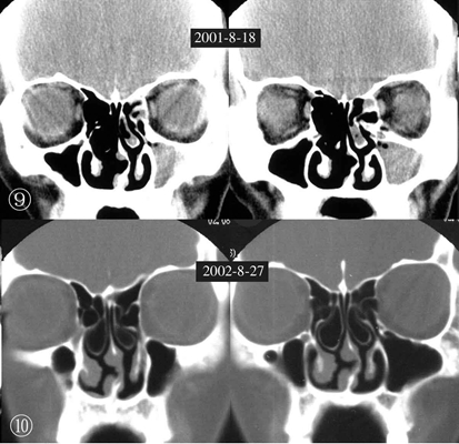 鼻中隔彎曲手術圖解 (44) 