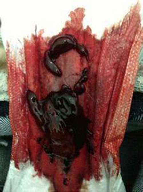 早孕藥流排出的孕囊