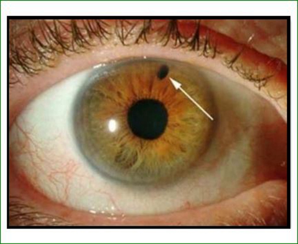 隅角閉鎖性青光眼