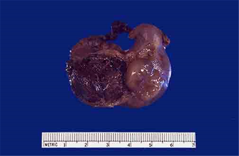 切除的輸卵管宮外孕