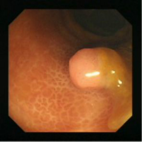 腫瘤性息肉圖的片 